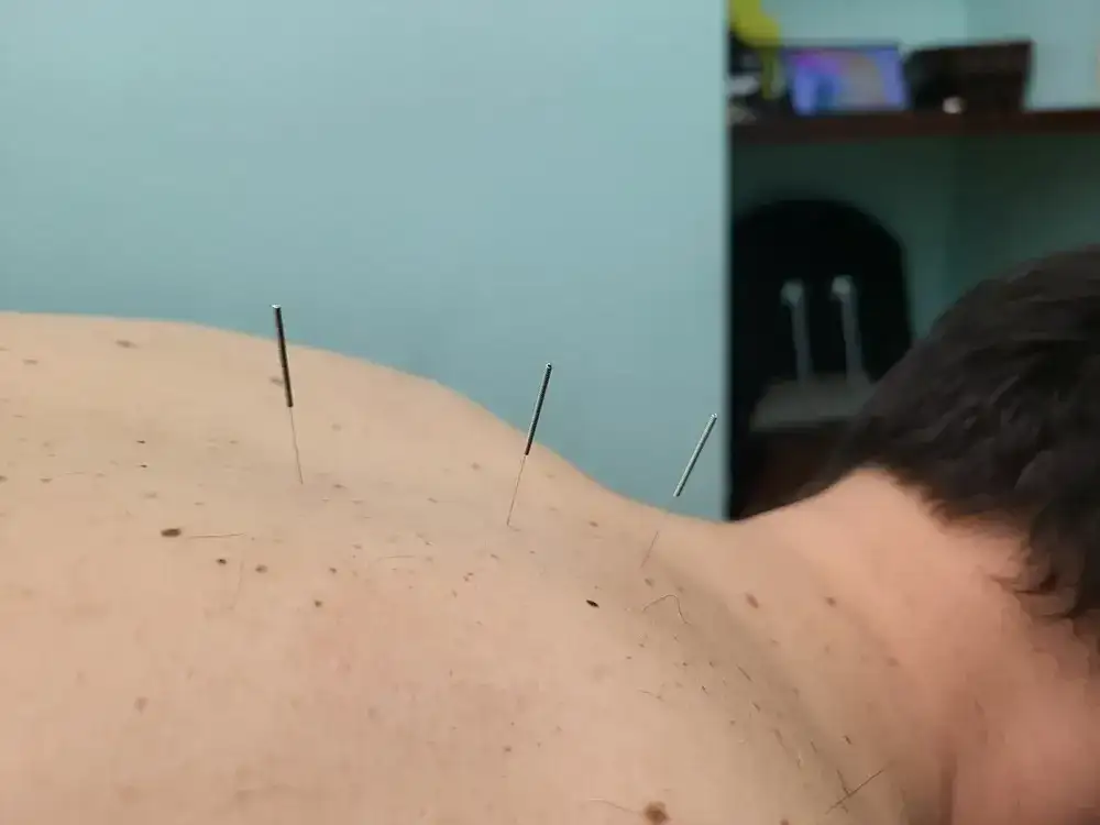 Medical Acupuncture image